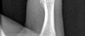 Avulsion fracture