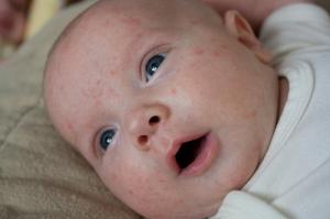 Baby acne treatment