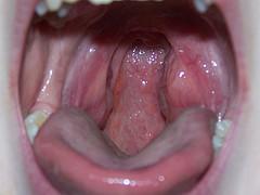 Bad breath after tonsillectomy