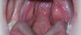 Bad breath after tonsillectomy