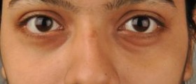 Bags under eyes causes