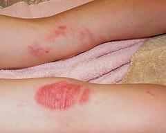 Baking soda eczema cure