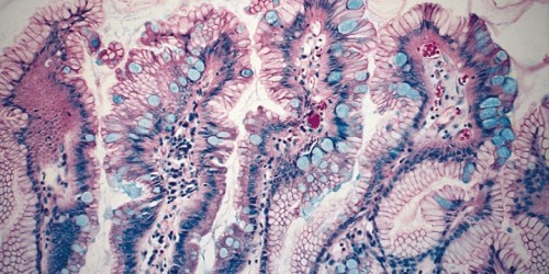 Barrett's Esophagus: What Is It?