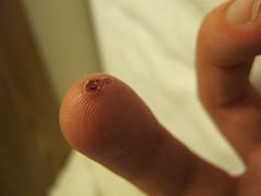 Basic facts about fever blisters