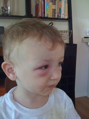 Bee sting allergy