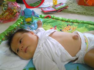 Belly button hernia