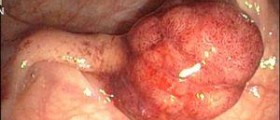 Benign colon polyps