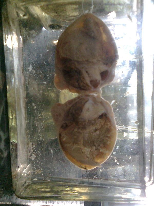 Benign cranial hypertension