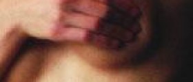 Benign cyst in breast
