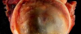 Benign cyst on ovary