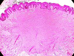Benign dermatofibroma facts