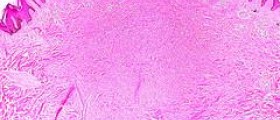 Benign dermatofibroma facts