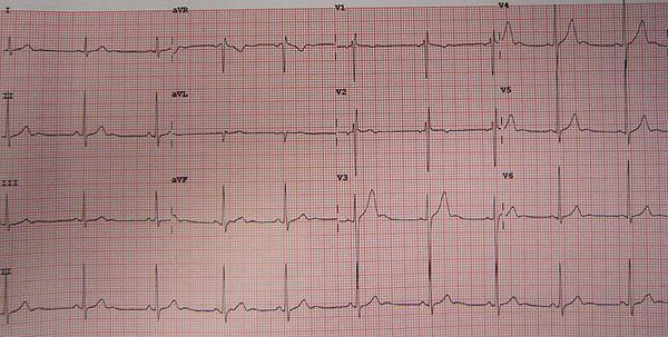 Benign ductal ectasia