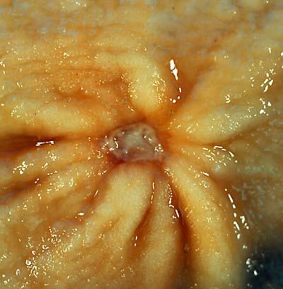 Benign functional ovarian cysts