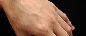 Benign ganglion cyst