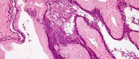 Benign gastric ulcer