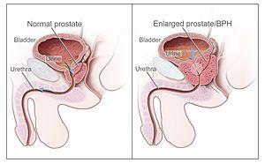 Benign genital warts