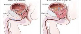 Benign genital warts