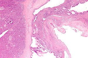 Benign germ cell tumor