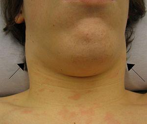 Benign lymph node
