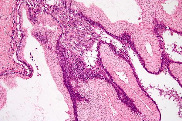 Benign nephrosclerosis facts