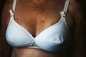 Benign nipple conditions