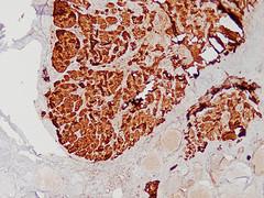 Benign nodules on thyroid