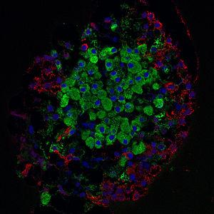 Benign pancreatic tumor