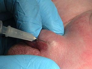 Benign penile lesions