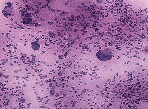 Benign pineal tumor