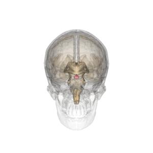 Benign pituitary adenoma