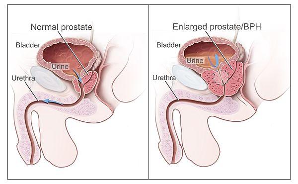 Benign positional vertigo exercises