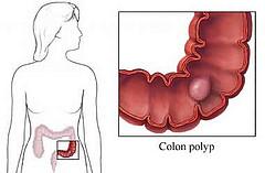 Benign rectal polyp
