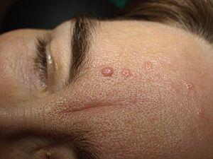 Benign seborrhoeic keratosis