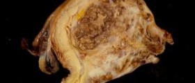 Benign tumor in liver