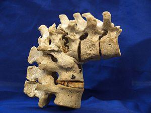 Benign tumour on spine
