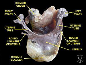 Benign uterine fibroids