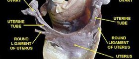 Benign uterine fibroids