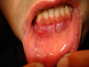 Best medication for ulcers