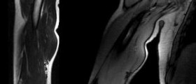 Bicep tendon tear