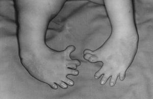 Birth defects list