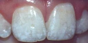 Black spots on teeth