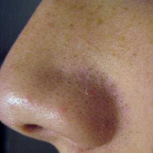 Blackhead removal - get rid of blackheads