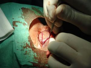 Blepharoplasty complications and risks