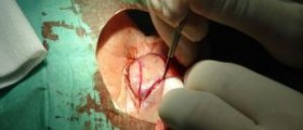 Blepharoplasty complications and risks