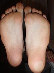 Blisters on feet