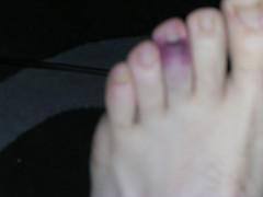 clot waffle on foot