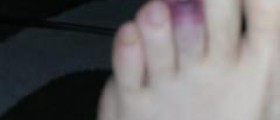 Blood clot in foot