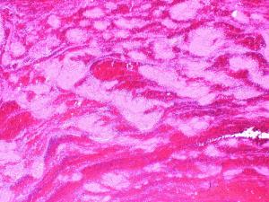 Blood clots after surgery