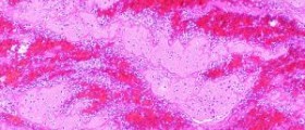 Blood clots in period
